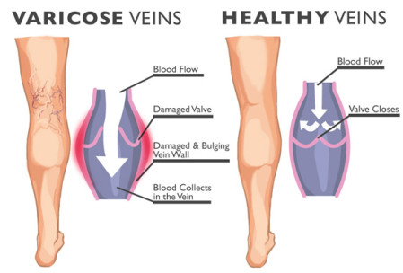 Varicose Veins Condition