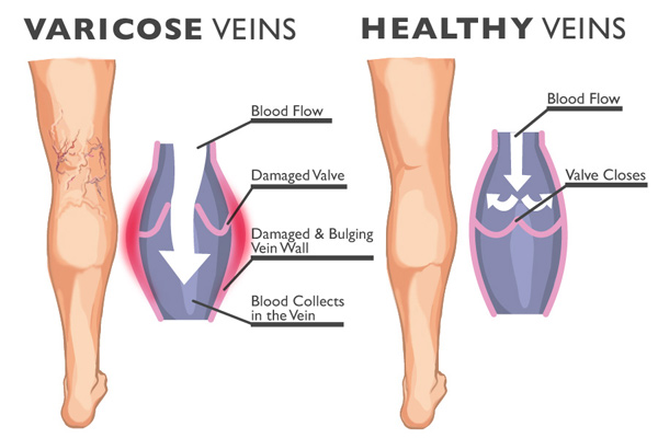 Varicose Veins Condition